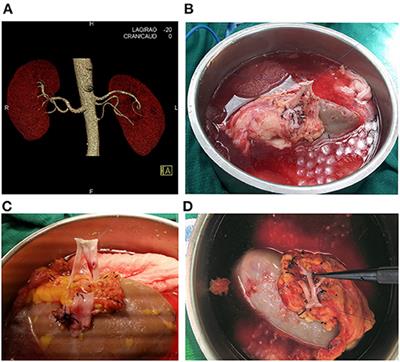 Clinical Outcomes Following Single vs. Multiple Vessel Living-Donor Kidney Transplantation: A Retrospective Comparison of 210 Patients